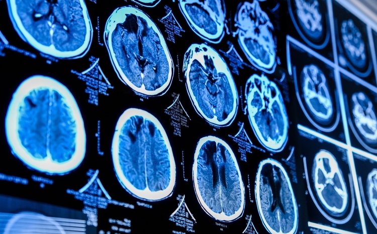 Close-up of multiple brain scan images displayed on a screen, showing detailed cross-sectional views of brain anatomy.
